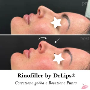 Corso Rinofiller — Dr Lips