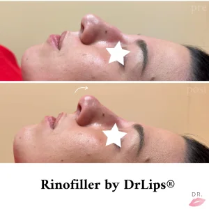 Rinofiller live injection — Dr Lips