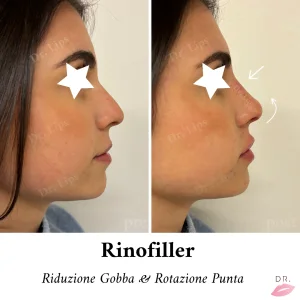 Masterclass Rinofiller — Dr Lips