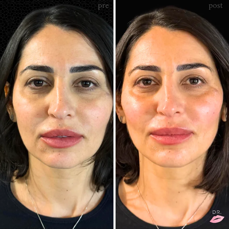 Biorivitalizzazione viso prima e dopo - risultato trattamento idratante caso 1 - Dr. Lips Milano