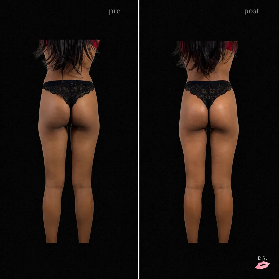Filler glutei prima e dopo - aumento volume glutei vista posteriore - Dr. Lips