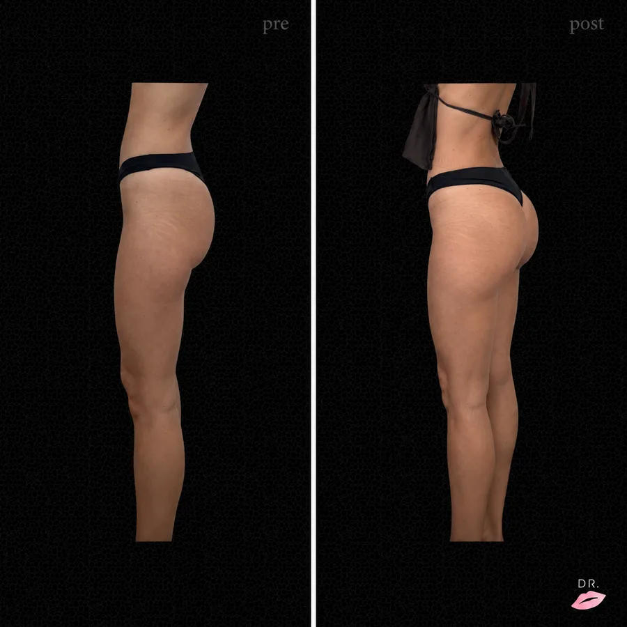 Filler glutei prima e dopo - profilo sinistro, rimodellamento glutei senza chirurgia - Dr. Lips