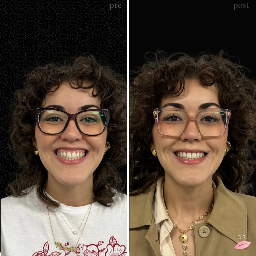 Gummy smile prima e dopo - correzione sorriso gengivale caso 1 - Dr. Lips Milano