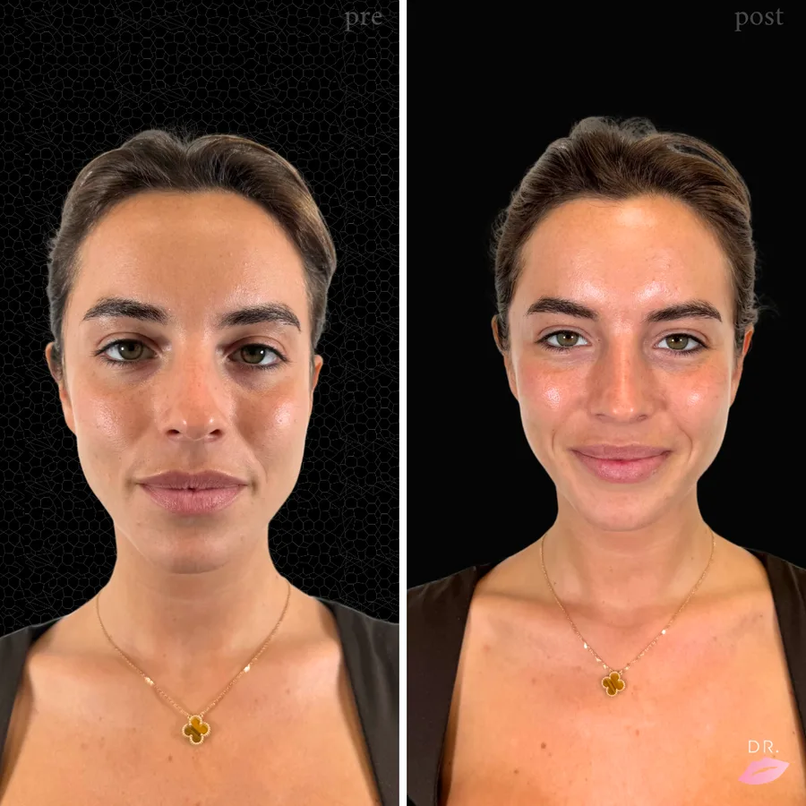 HydraFacial prima e dopo - pulizia profonda viso caso 1 - Dr. Lips Milano