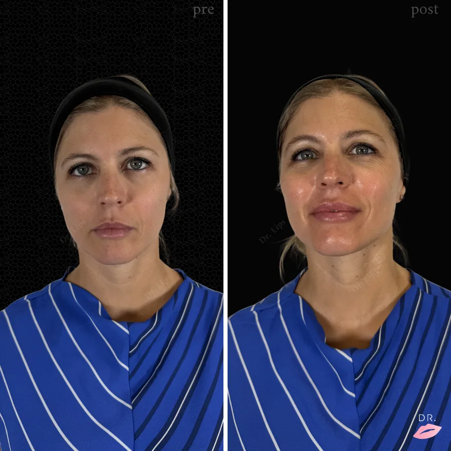 HydraFacial prima e dopo - luminosità e idratazione pelle caso 2 - Dr. Lips