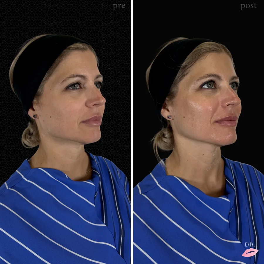 HydraFacial prima e dopo - trattamento pelle mista e grassa caso 3 - Dr. Lips