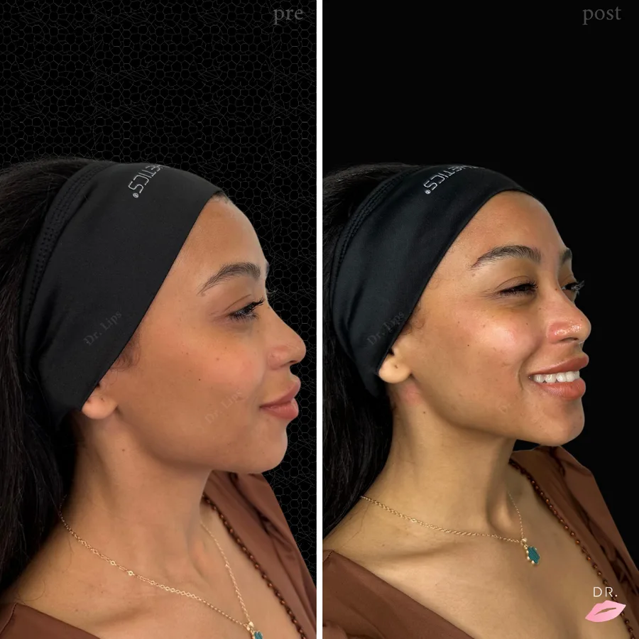 HydraFacial prima e dopo - ringiovanimento cutaneo caso 4 - Dr. Lips