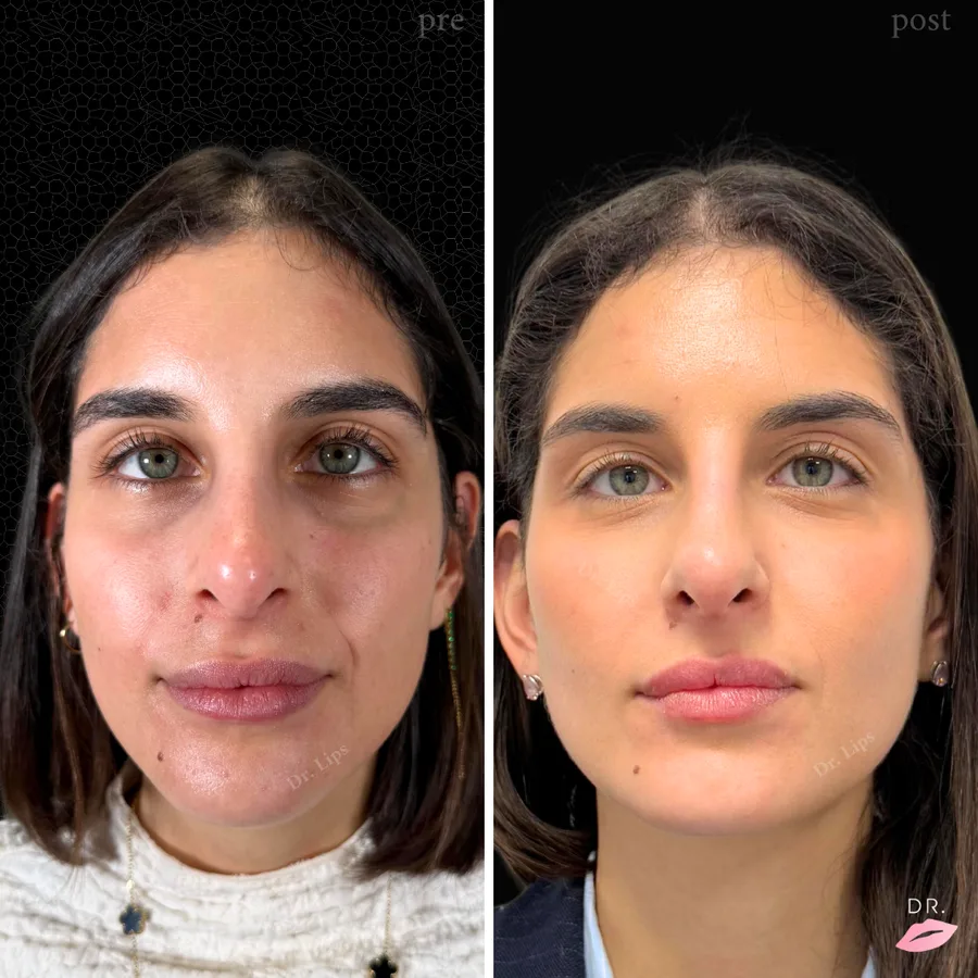 Occhiaie senza bisturi prima e dopo - correzione occhiaie con filler caso 1 - Dr. Lips Milano