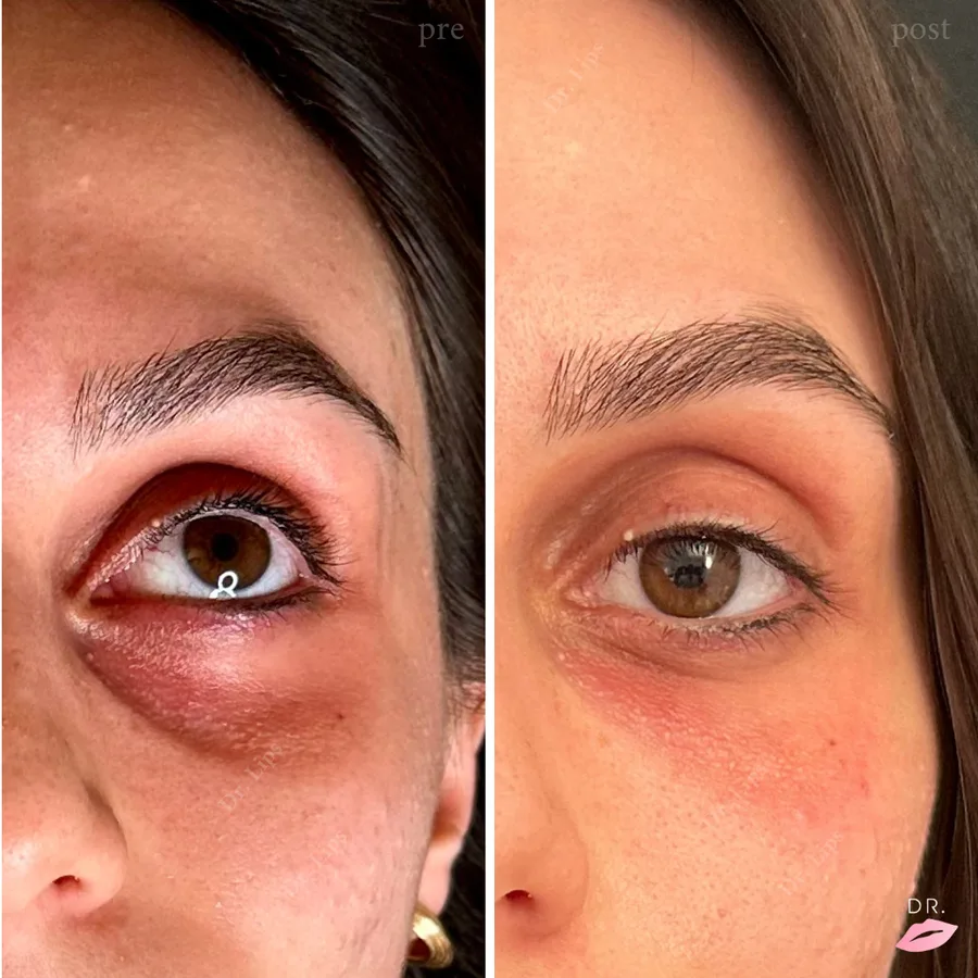 Occhiaie senza bisturi prima e dopo - risultato trattamento caso 2 - Dr. Lips