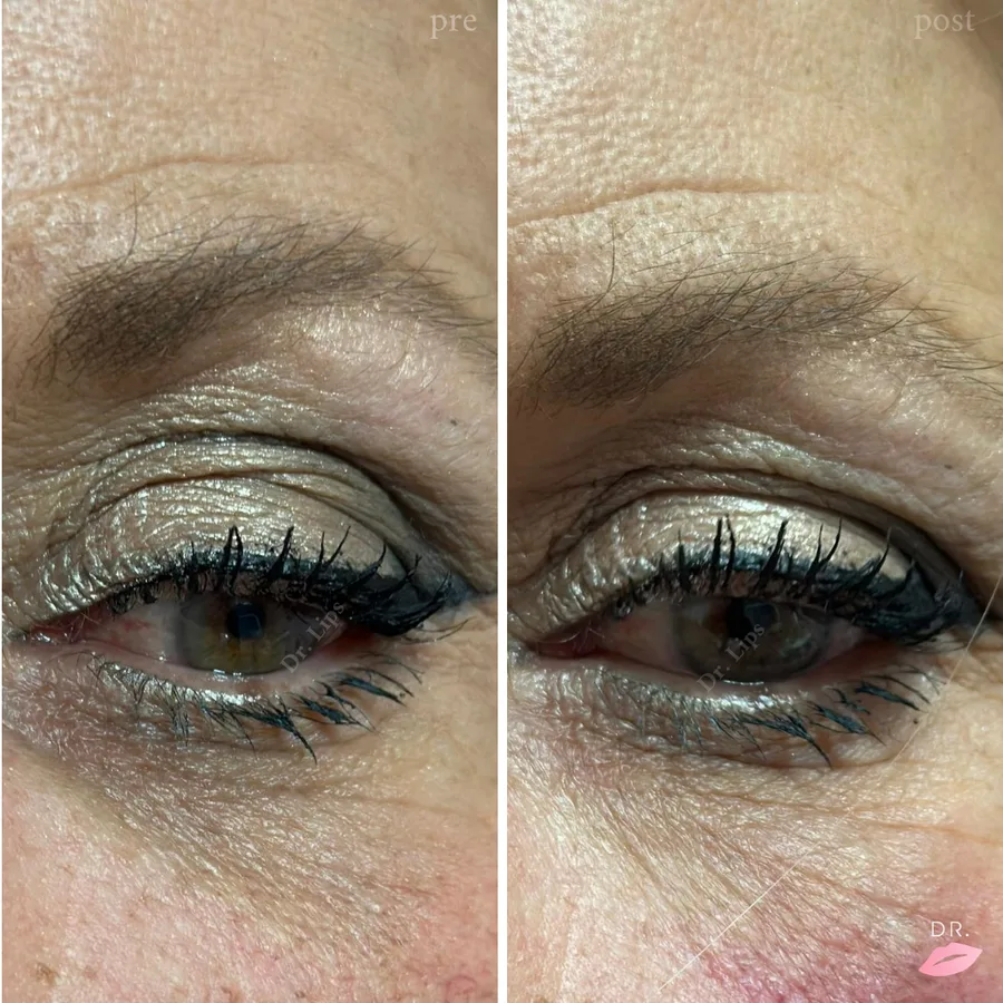 Occhiaie senza bisturi prima e dopo - filler occhiaie valle lacrimale caso 3 - Dr. Lips