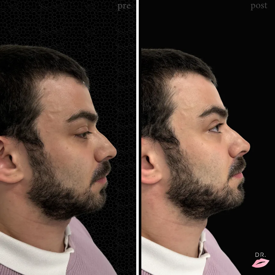 Rinofiller prima e dopo - correzione naso senza chirurgia caso 1 - Dr. Lips Milano