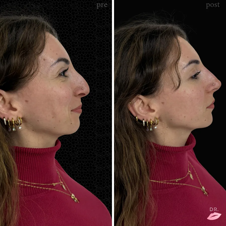 Rinofiller prima e dopo - rinoplastica non chirurgica caso 2 - Dr. Lips