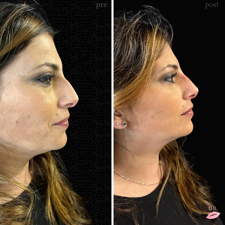 Rinofiller prima e dopo - correzione gobba nasale caso 3 - Dr. Lips