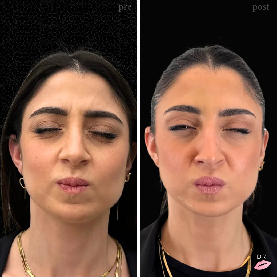 Botulino rughe fronte prima e dopo - trattamento rughe glabellari caso 2 - Dr. Lips
