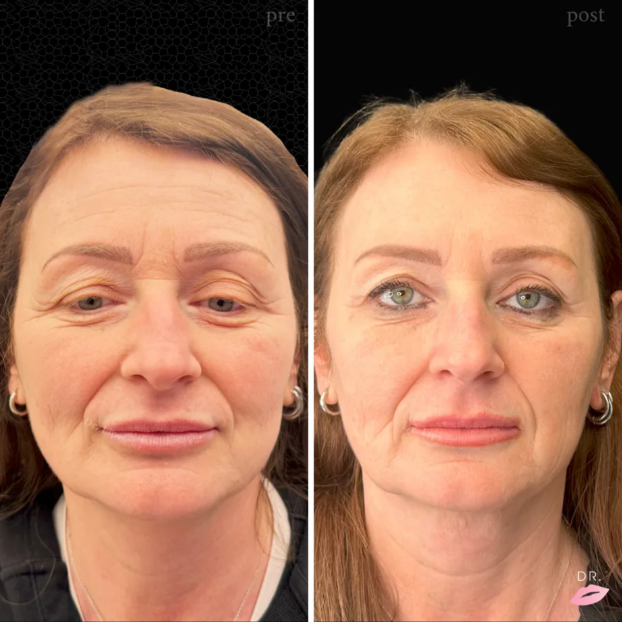 Botulino rughe fronte prima e dopo - lifting non chirurgico caso 4 - Dr. Lips