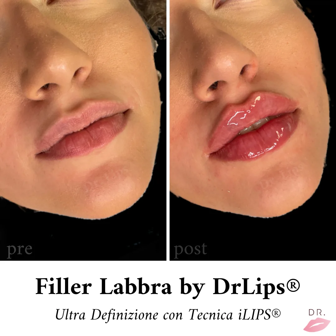 Filler Labbra - tecnica iLips Dr Lips