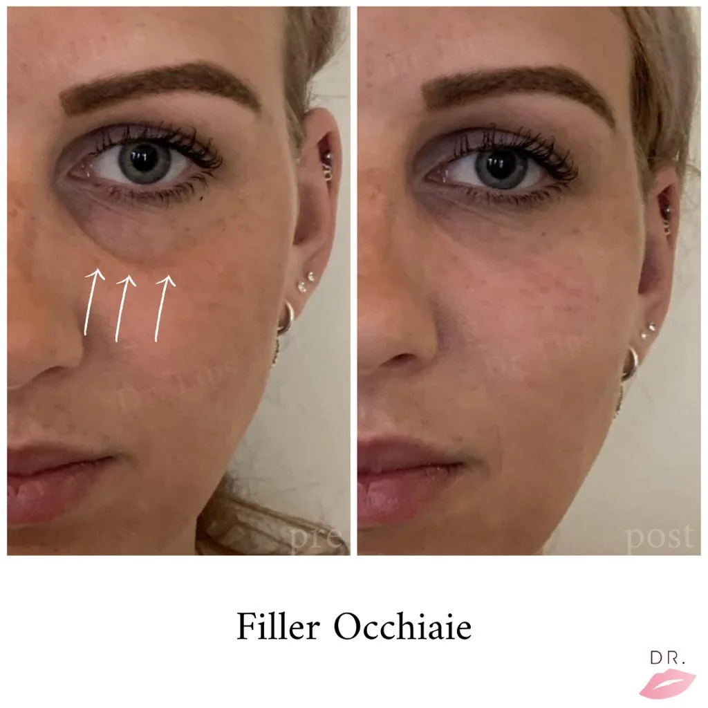 Occhiaie senza bisturi Dr Lips — filler occhiaie risultato naturale