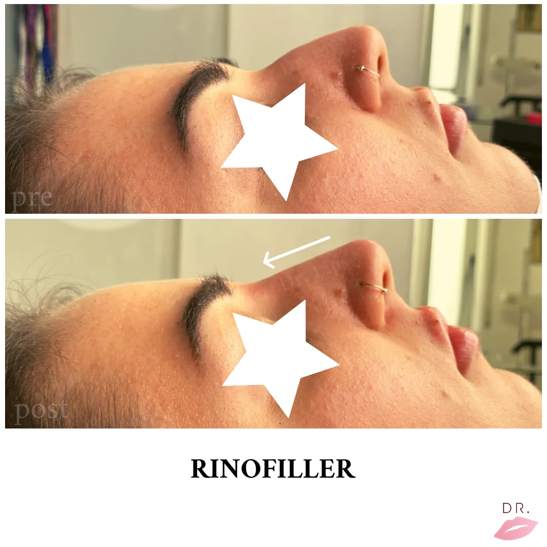 Rinofiller eliminazione gobba nasale