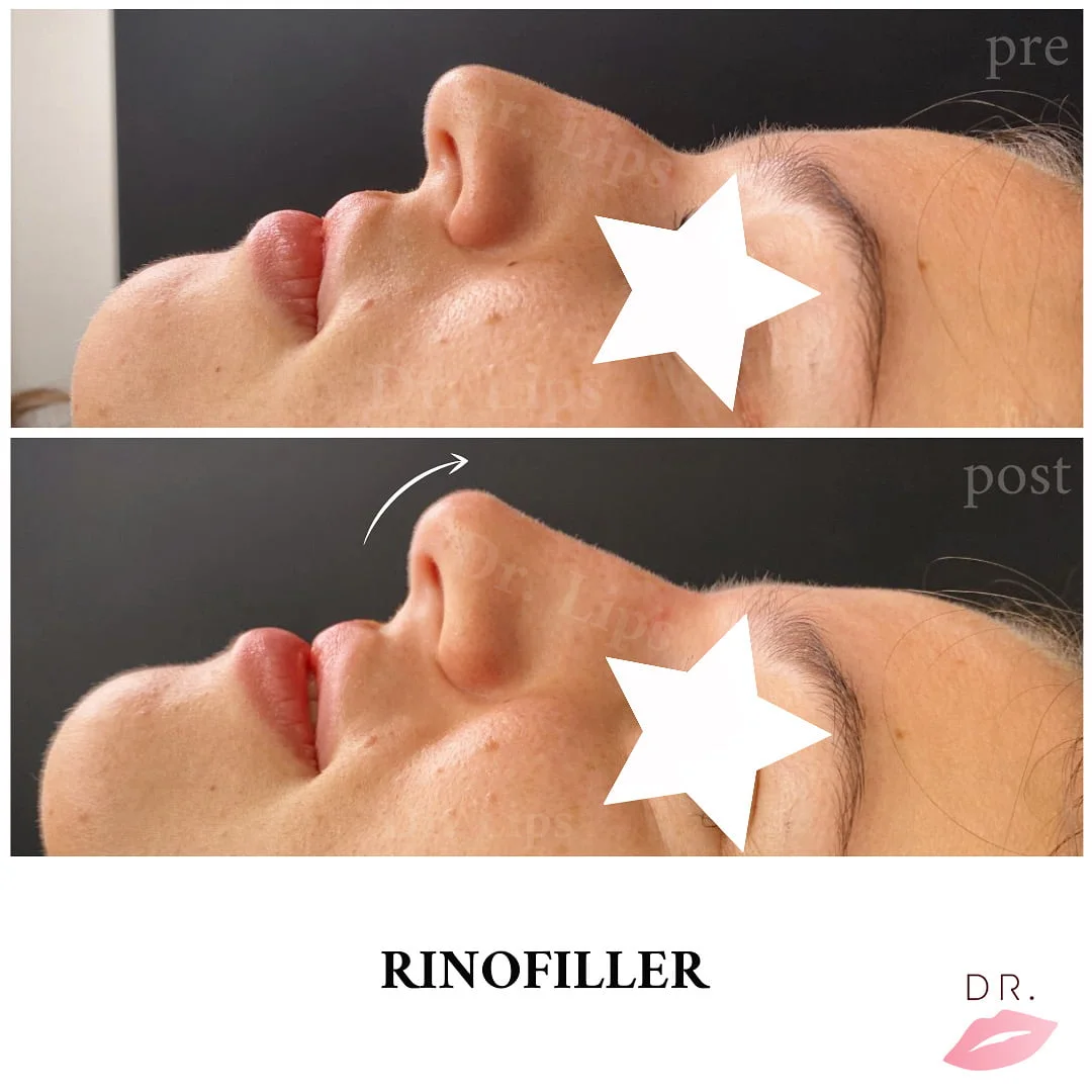 Rinofiller innalzamento punta del naso