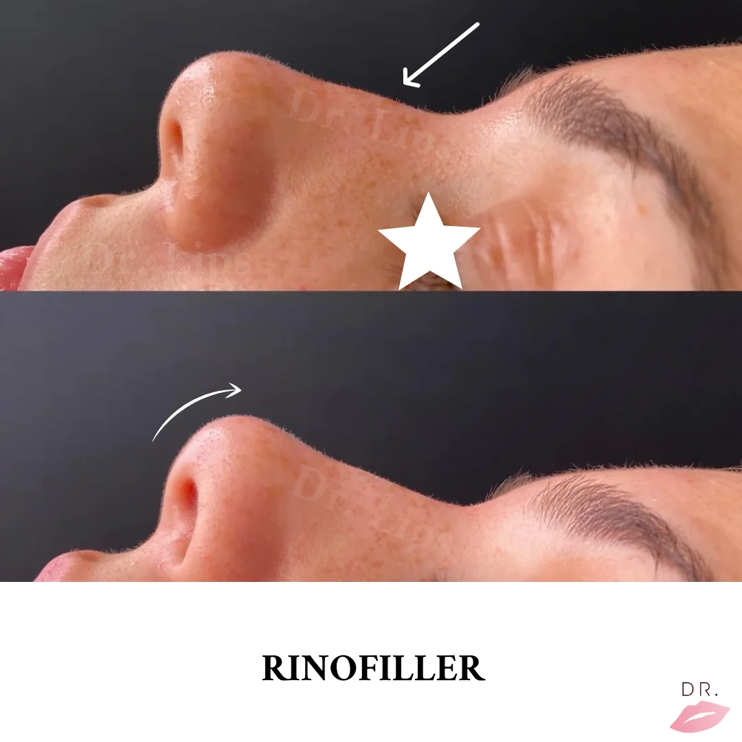 Rinofiller correzione punta del naso
